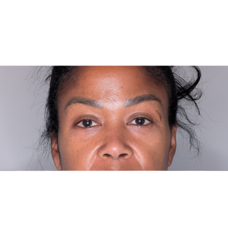 Brow Lift case #6399