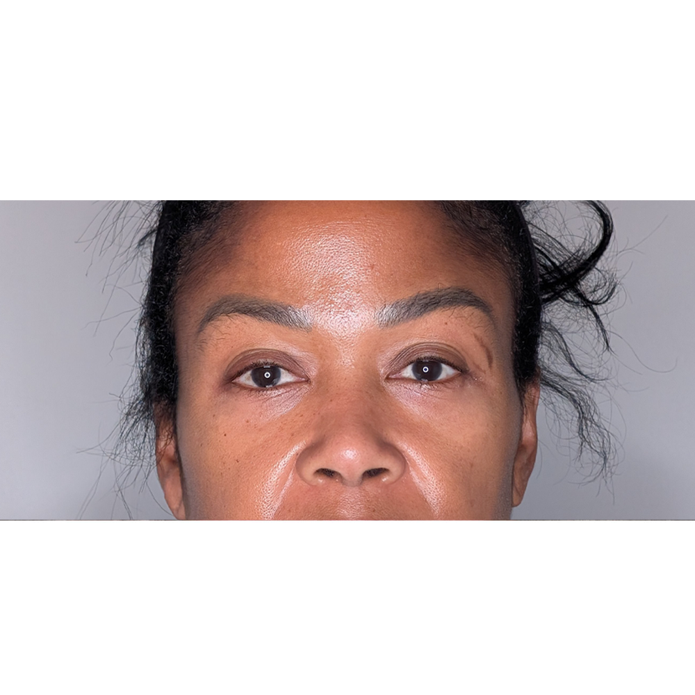 Brow Lift case #6399