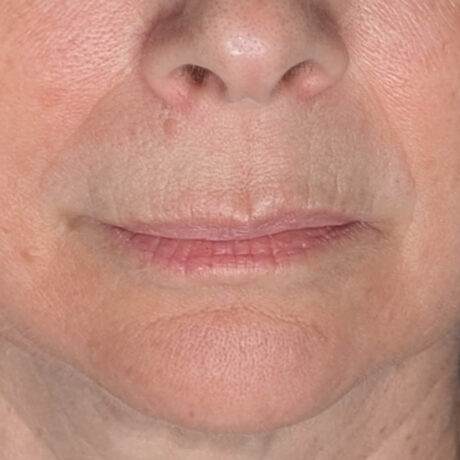 Lip Filler case #6654
