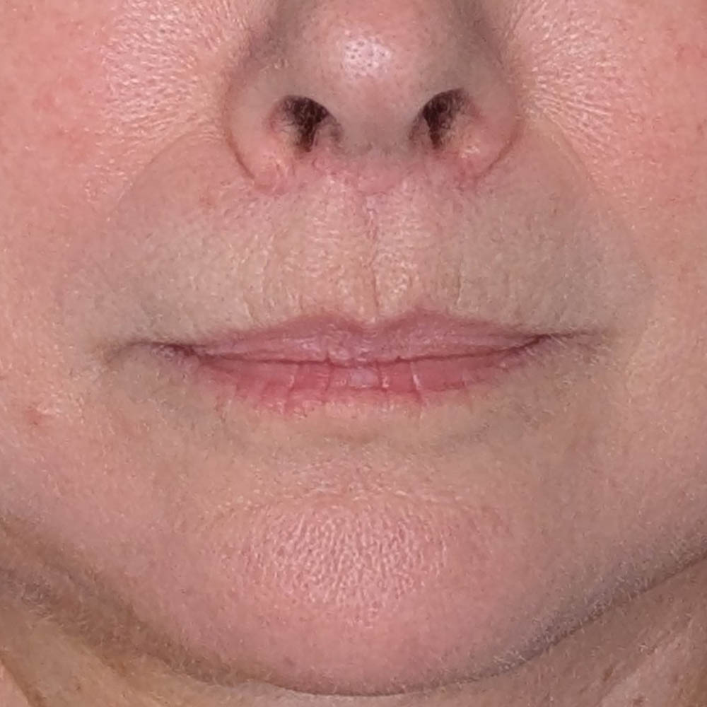 Lip Filler case #6654