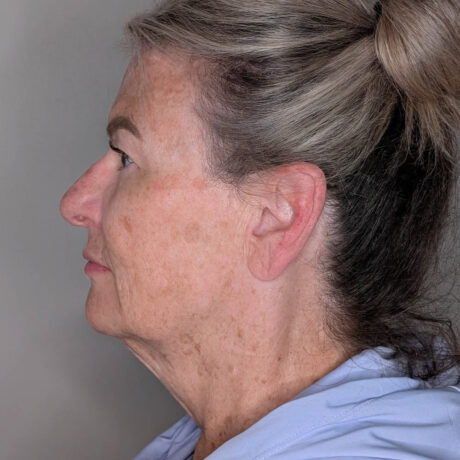 Facelift case #6666