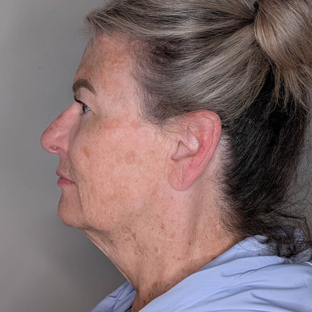 Facelift case #6666