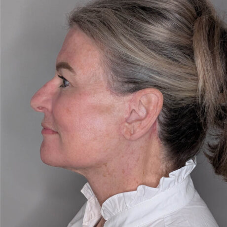 Facelift case #6666