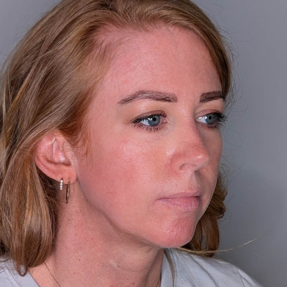 Fillers case #6672