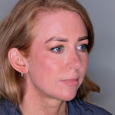 Fillers case #6672