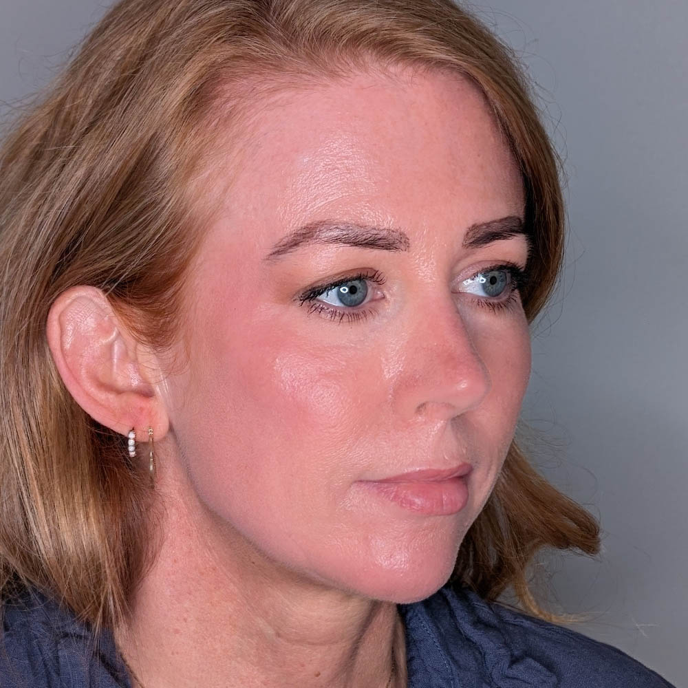 Fillers case #6672