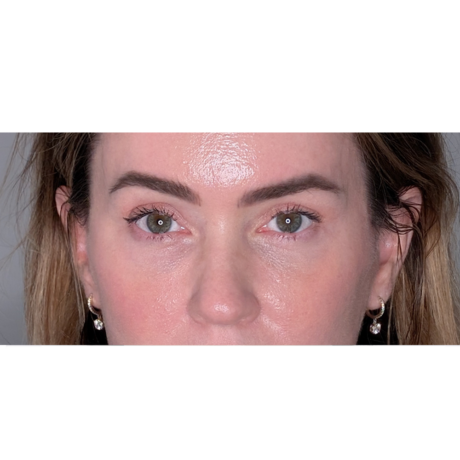 Brow Lift case #6645