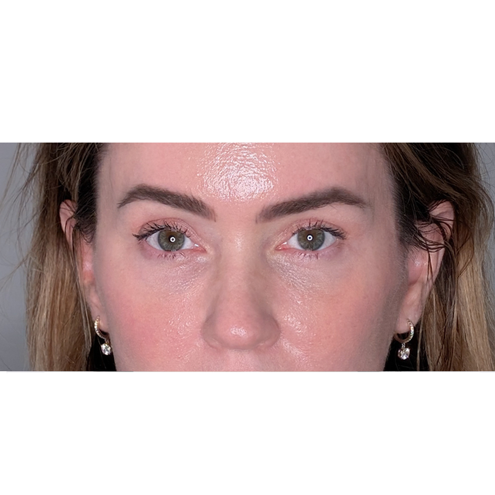 Brow Lift case #6645