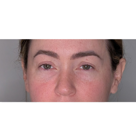 Brow Lift case #6645